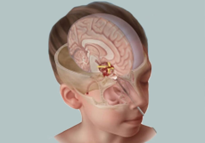 Pediatric Neurosurgery